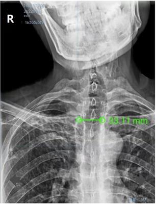 Unexpected curious cause of serious air leakage after endotracheal intubation: A case report of tracheobronchomegaly and literature review